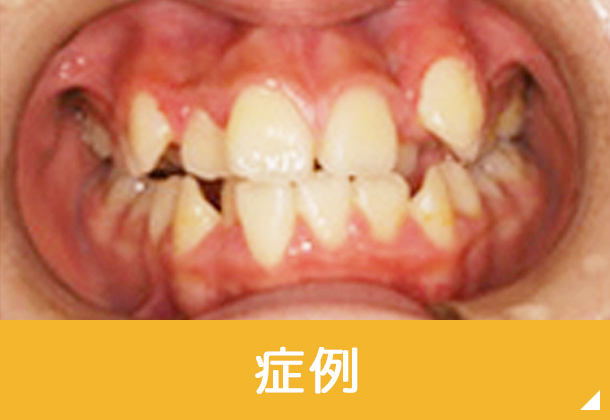 症例